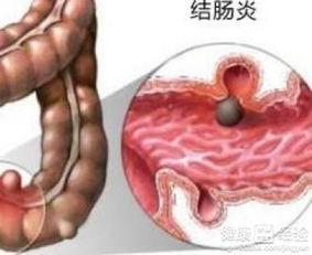 结肠炎吃拉瓜